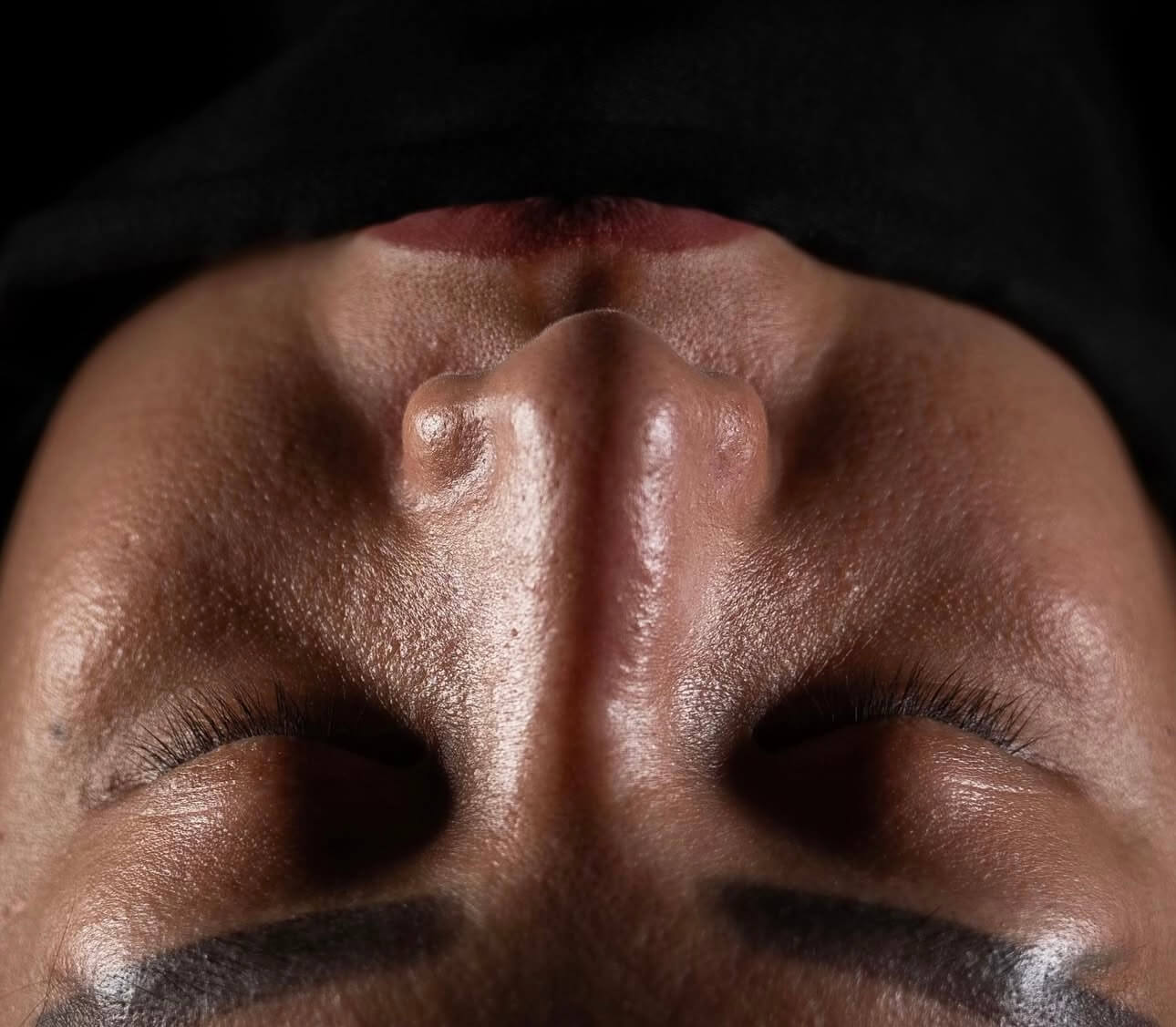 Ринопластика